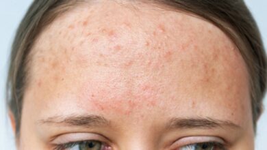 Photo of Un grupo de dermatólogos ofrece la guía más reciente sobre el acné