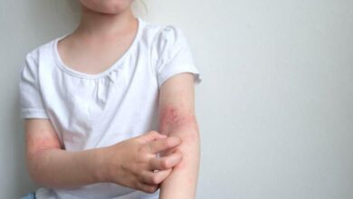 Photo of El vapeo en lugares cerrados favorecer la aparición de dermatitis atópica en los niños