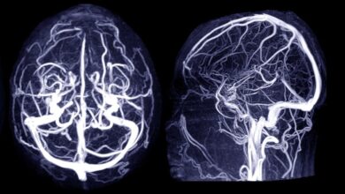Photo of Fármacos para el colesterol, la diabetes y la hipertensión pueden reducir el riesgo de aneurismas cerebrales