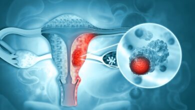 Photo of El 70% de los casos de cáncer de ovarios se detecta en estadios avanzados