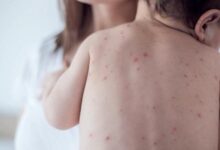 Photo of Alerta sanitaria por cuatro brotes activos de sarampión