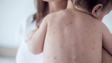 Photo of Alerta sanitaria por cuatro brotes activos de sarampión